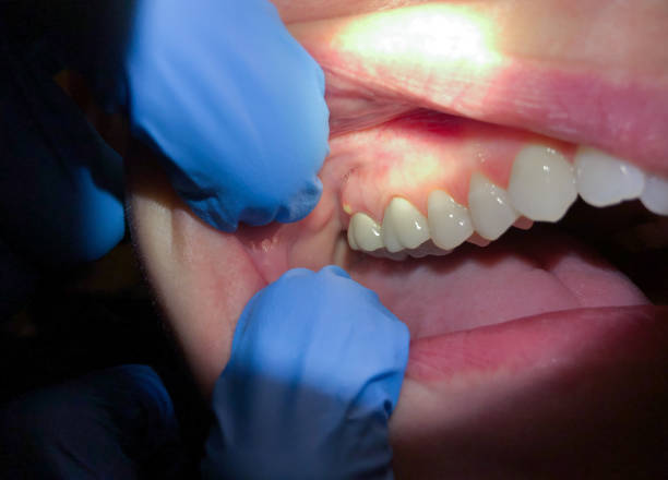 Best Tooth Infection Emergency Dentist  in Genoa City, WI